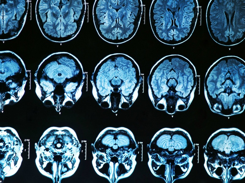 hersenscans