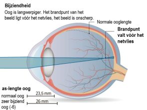 Uitleg van bijziendheid