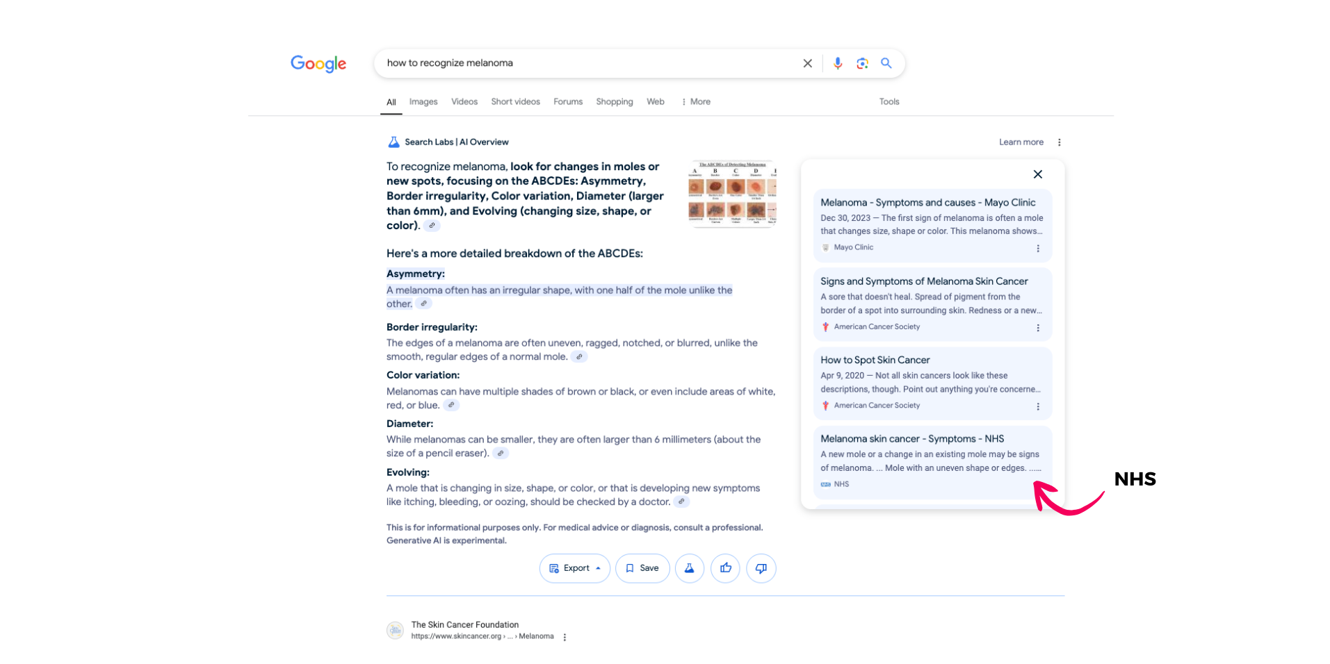 AI overview bij 'how to recognize melanoma' met bron uitgelicht